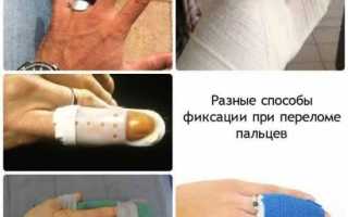 Лангетка на палец руки: описание, способы наложения, эффективность, фото