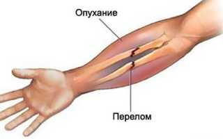 Перелом костей предплечья