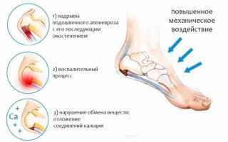 Как убрать шипы в пятках в домашних условиях?