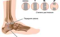 Растяжение связок голеностопа