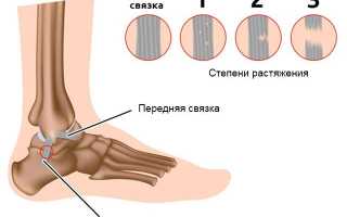 Растяжение связок голеностопа
