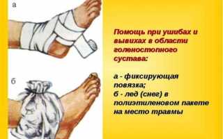Ушиб голеностопа