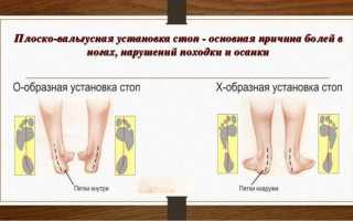 Что такое плоско-вальгусная стопа у ребенка и как ее лечить
