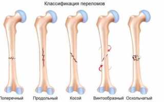 Перелом предплечья: симптомы, лечение и реабилитация