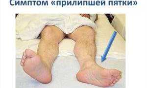 Симптом прилипшей пятки при переломах позвоночника