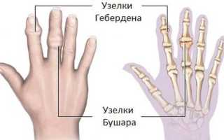 Артроз пальцев рук