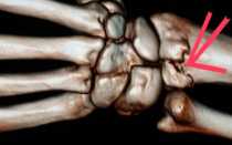 Сосуды кисти анатомия