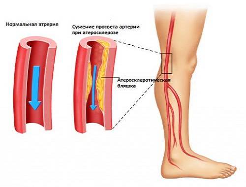Ангиопатия