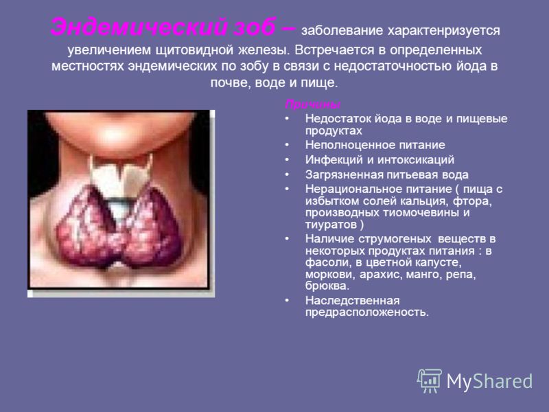 Эндемический зоб