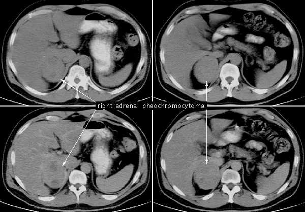 Феохромоцитома