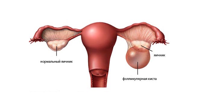 Фолликулярная киста