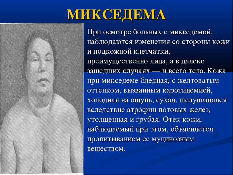 Микседема
