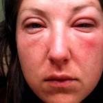 Отек лица при гипотиреозе