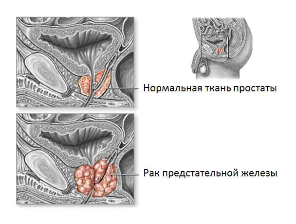 Рак предстательной железы