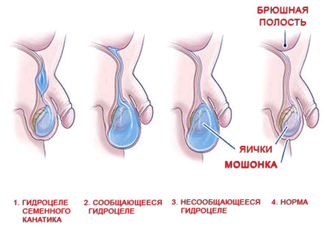 Водянка яичка