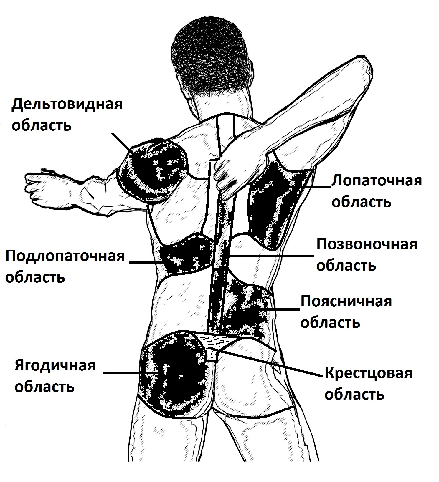 Локализация болей при пиелонефрите Локализация болей