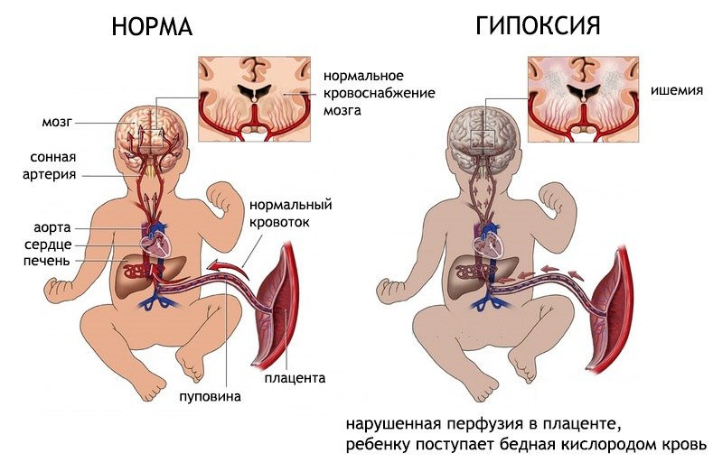 Чем опасен уреаплазмоз для ребенка Опасность заболевания для ребенка