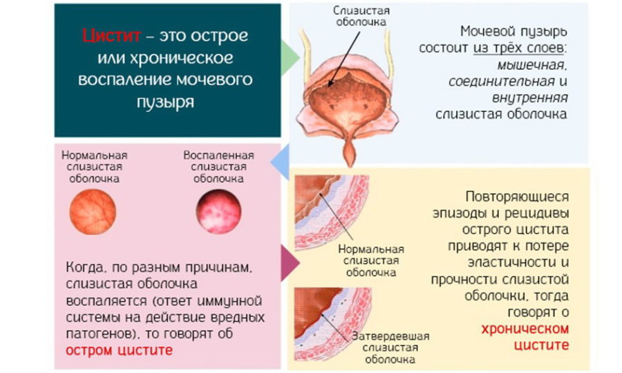 Цистит у женщин Как проявляется цистит у женщин