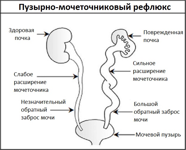 Схематическое отображение Пузырно-мочеточниковый рефлюс Что такое ПМР