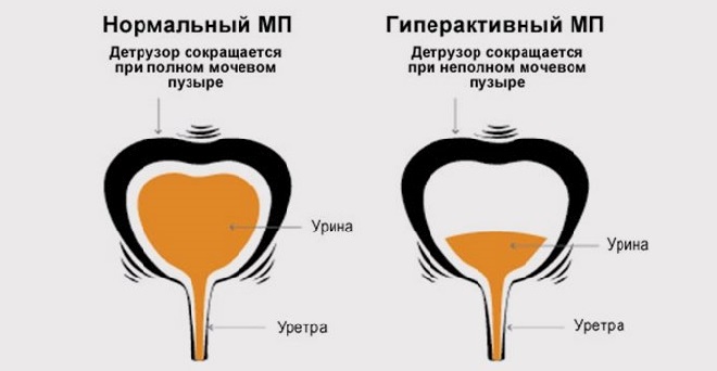 Как устроен нейрогенный мочевой пузырь Что такое нейрогенный мочевой пузырь