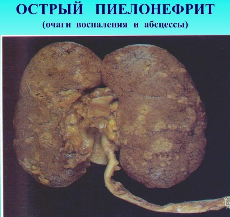 Как выглядит острый пиелонефрит у человека Как выглядит острый пиелонефрит