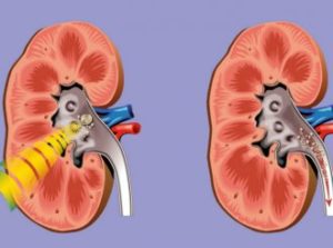 Лечение с помощью ДЛТ лечение с помощью сильной волны