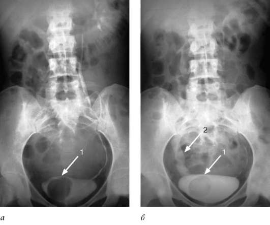 Диагностика заболевания уретероцеле Диагностика заболевания