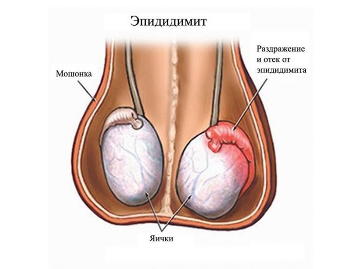 Эпидидимит Эпидидимит