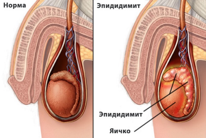 Эпидидимит