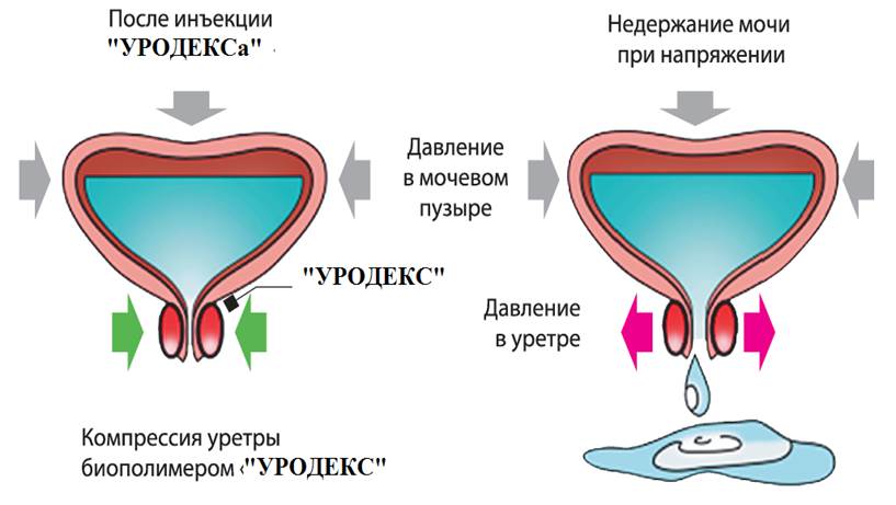 Инъекции при недержании мочи у женщин Какие инъекции при недержании мочи у женщин