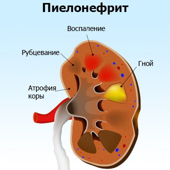 Как выглядит Пиелонефрит у женщин Как выглядит Пиелонефрит