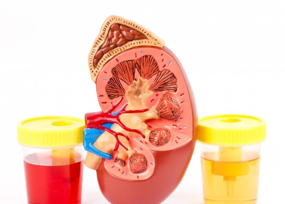 Кровь в Урине при цистите Кровь в Урине