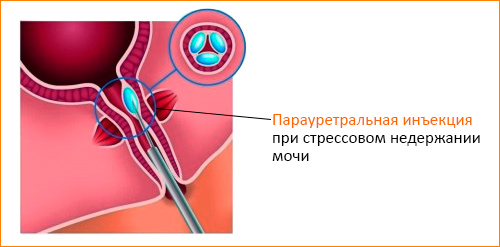 Как лечить недержание мочи Как лечить недержание мочи у женщин