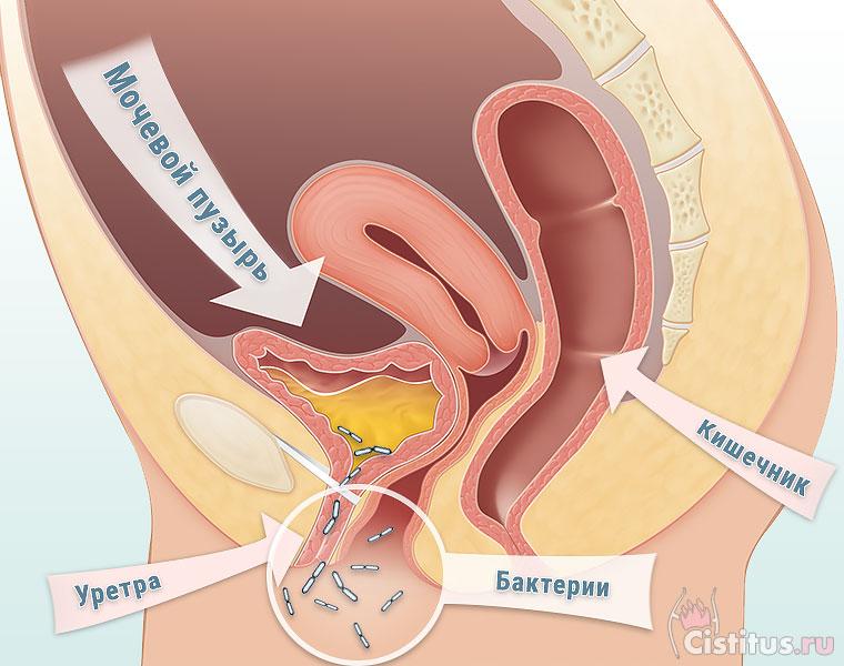 Лечение цистита у женщин Эффективное лечение цистита у женщин
