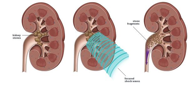 Литотрипсия - ударноволновое лечение МКБ Лечение МКБ