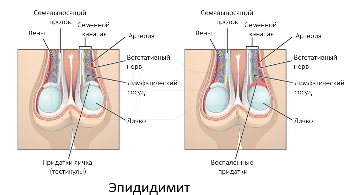 Симптомы неинфекционного эпидидимита Лечение неинфекционного эпидидимита