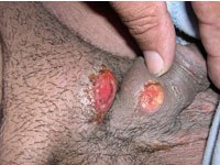 Что такое Некротическая гранулема Некротическая гранулема