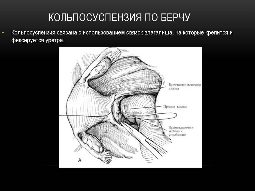 Операция по Берну при недержании мочи у женщин Операция по Берну при недержании мочи