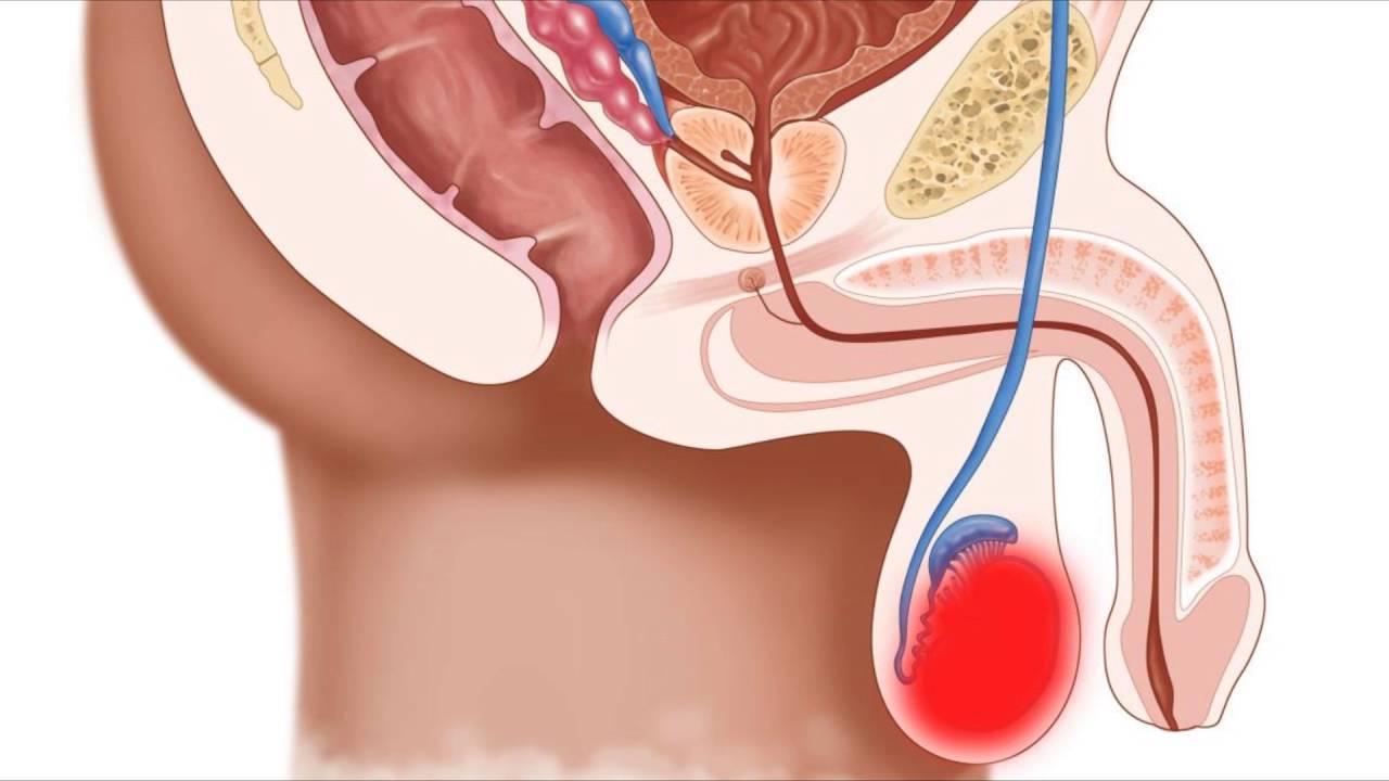 Симптомы острого эпидидимита Лечение острого эпидидимита