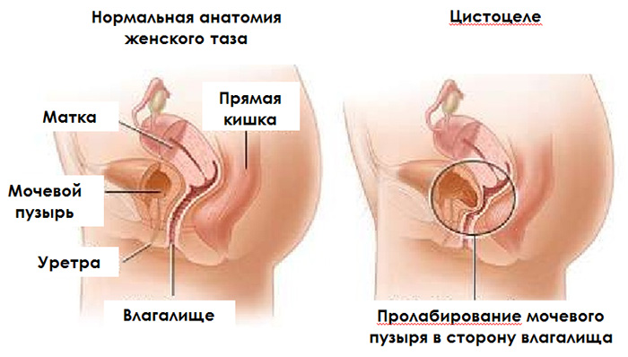 Возможные причины недержание мочи Почему возникает недержание мочи