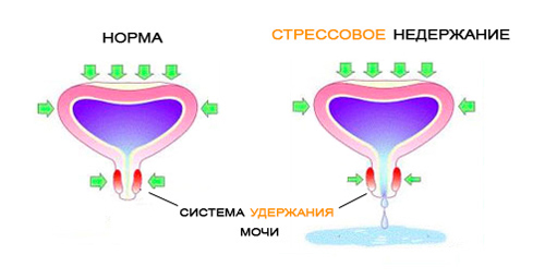Подростковый энурез Симптомы подросткового энуреза
