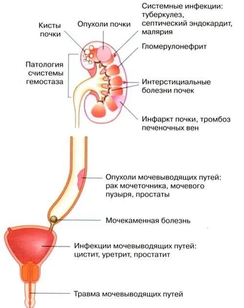 Возможные причины появления крови в моче Причины появления крови в моче