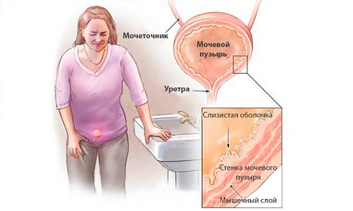 Причины цистита у мужчин Причины цистита