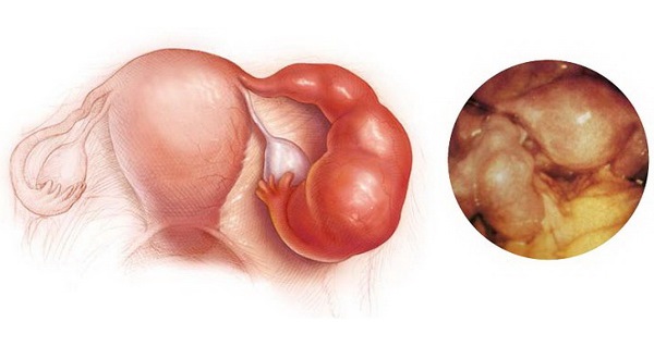 Микроплазмоза у женщин Микроплазмоза