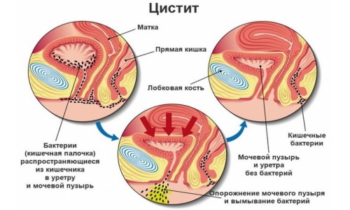 Что нужно знать о профилактике цистита Как избежать цистита