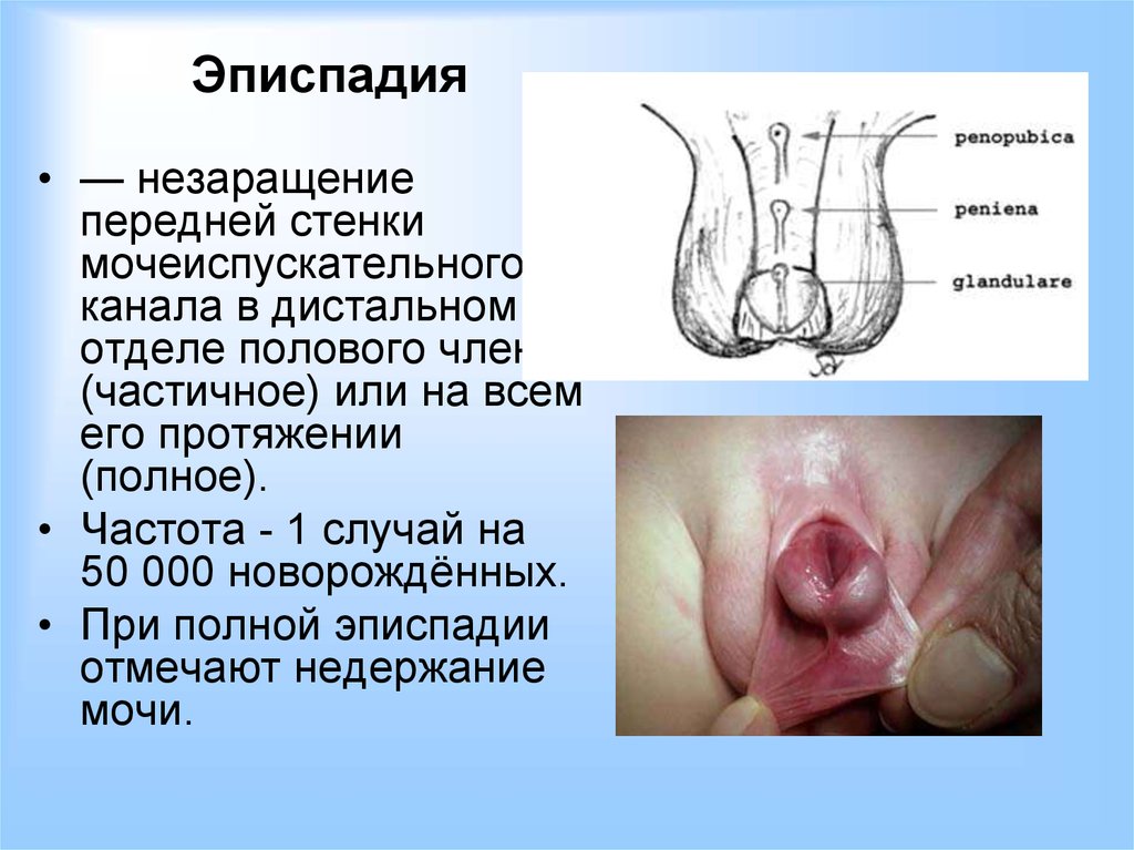 Симптоматика заболевания Симптоматика эписпадии