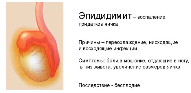 Симптомы и причины эпидидимита
