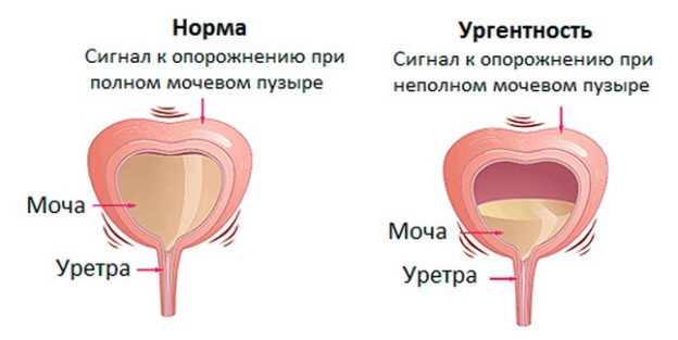 Какие симптомы недержания мочи Как проявляется недержание мочи