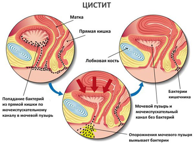 Как проявляется цистит у женщин Какие симптомы цистита
