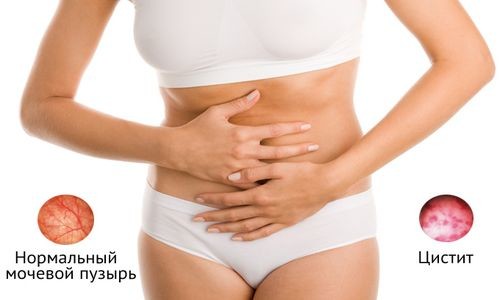 симптомы болезни цистит симптомы болезни